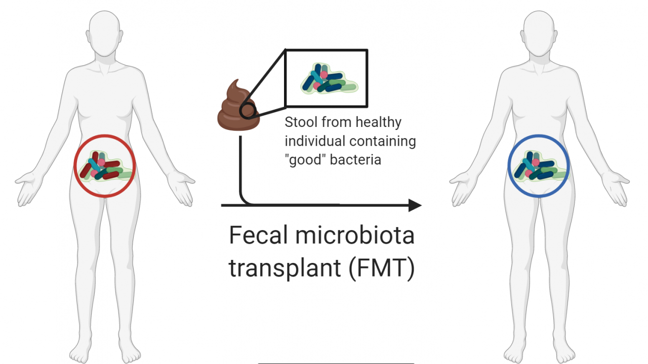 fecal transplants