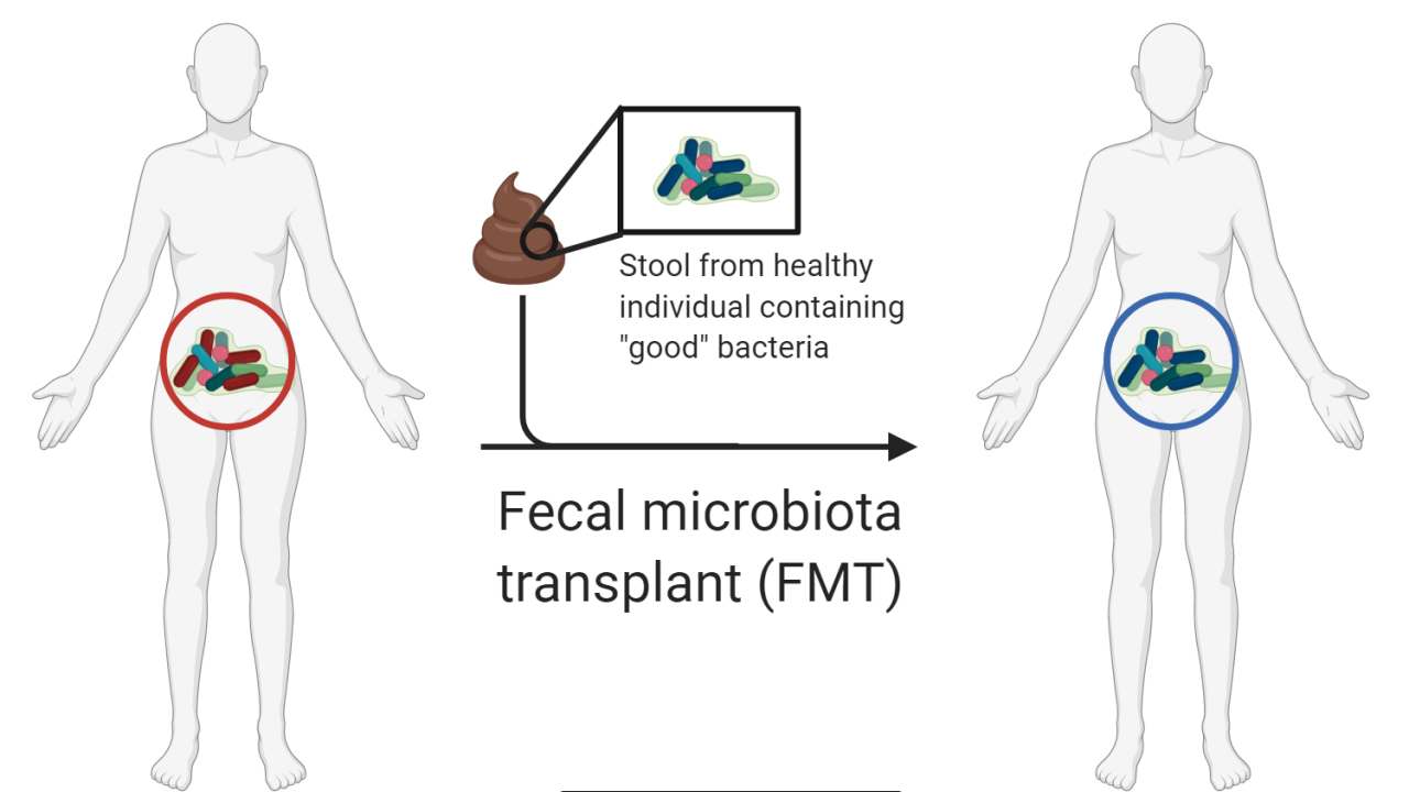 fecal transplants